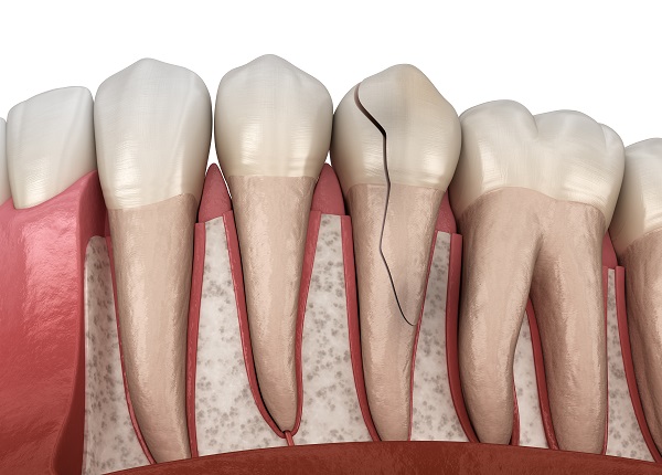 Dental Treatment Options for a Cracked Tooth - Columbia Advanced