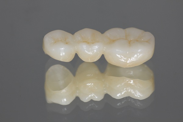 What Causes Dental Bridge Failure?