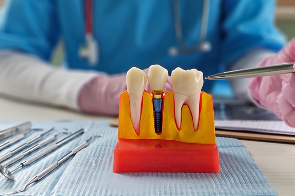 Teeth Replacement    : Dental Implants