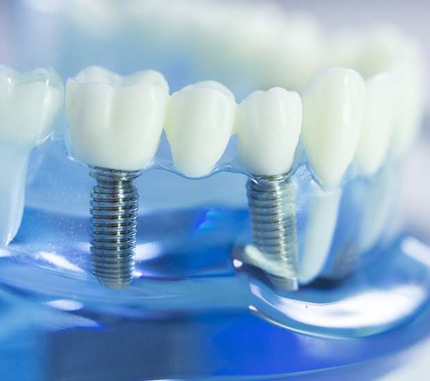 Columbia Dental Implants