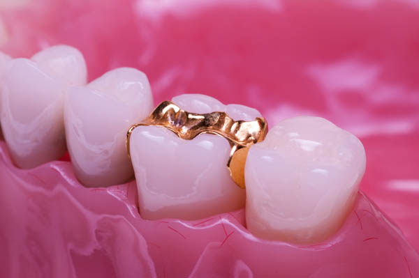 Tooth Filling Vs  Dental Inlay
