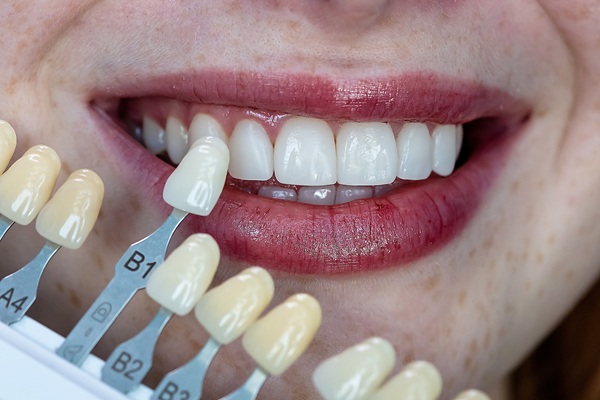 Dental Veneers: Is It Time To Repair Or Replace Them?