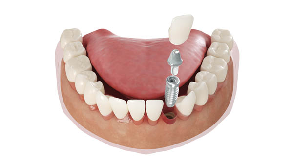 Implant Dentist Columbia, MD