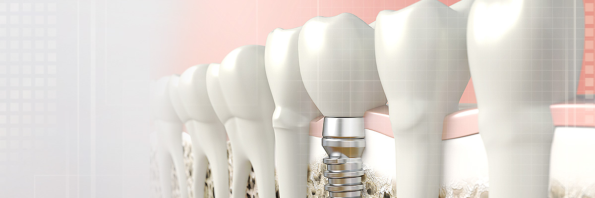 Columbia Implant Dentist