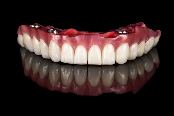 Tooth Replacement    : A Guide To Implant Supported Dentures