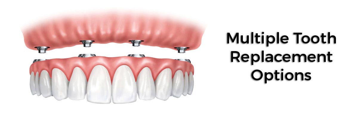 Columbia Multiple Teeth Replacement Options