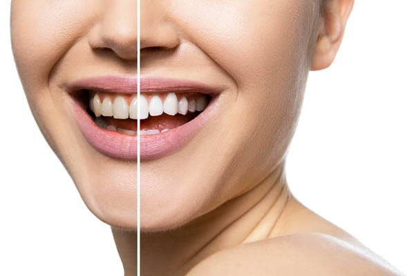 Popular Teeth Whitening Alternatives