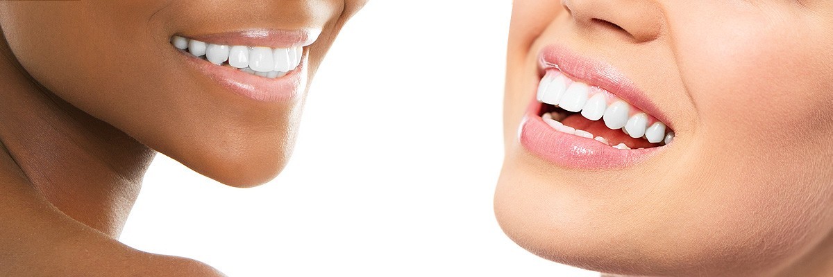 Columbia Teeth Whitening