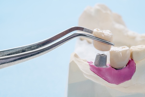 Can You Eat After Getting Tooth Implants?